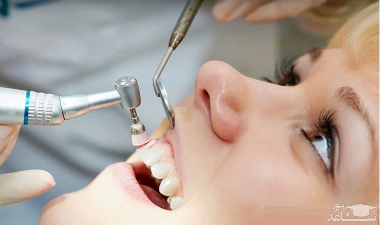 جرم گیری دندان و سلامت و بهداشت