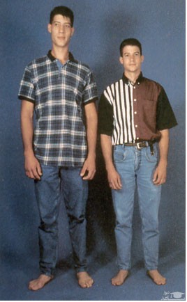 علل، علائم  آکرومگالی ( رشد بیش از اندازه بدن ) و راههای درمان آن