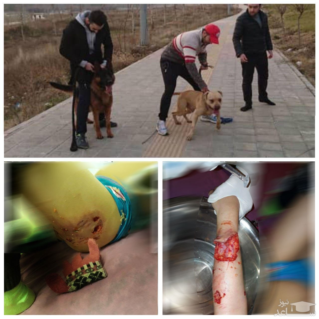 وضعیت دختر ۱۰ ساله‌ای که سگ‌ها در لواسان به او حمله کردند