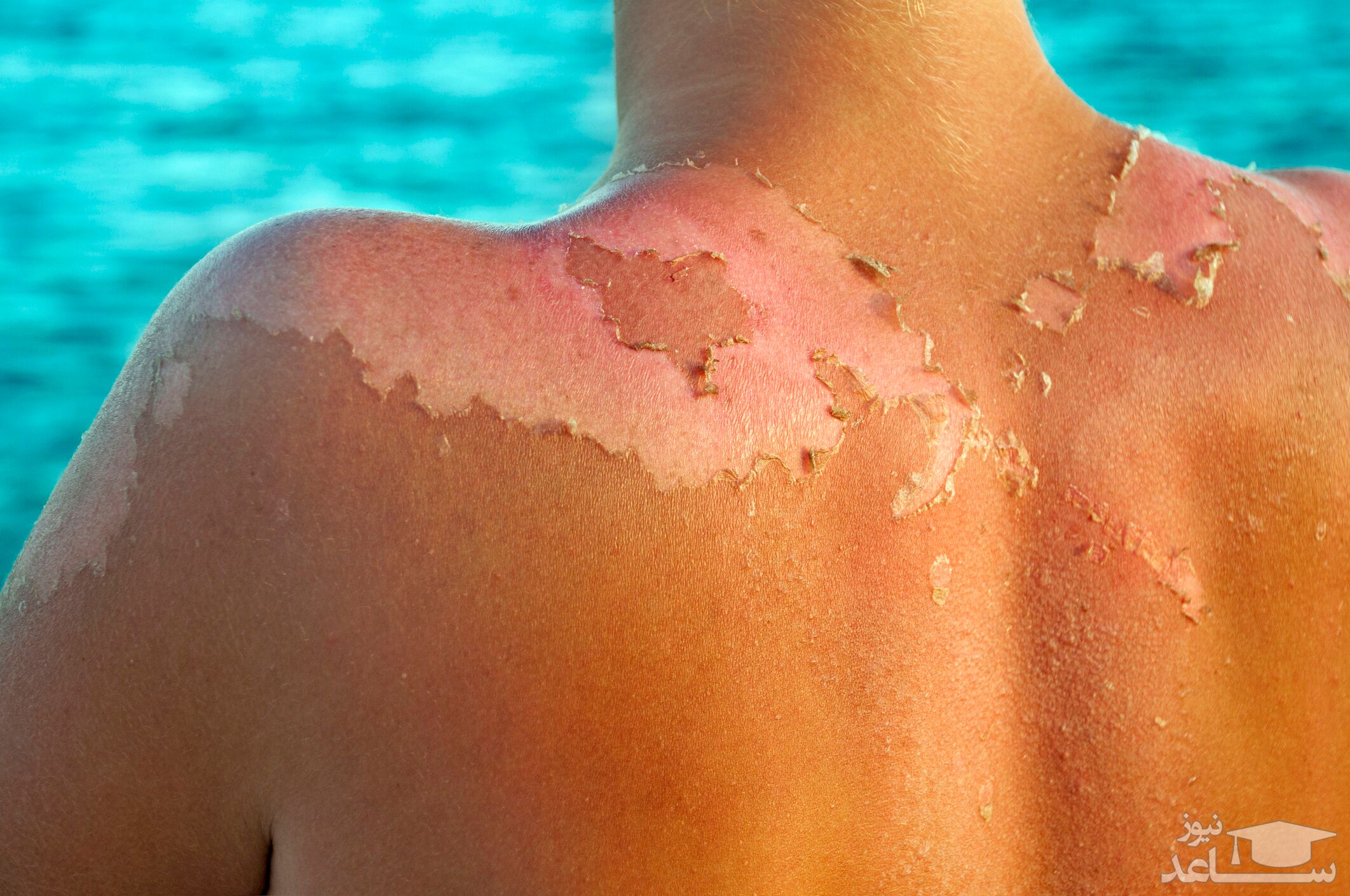 درمان آفتاب سوختگی با استفاده از داروهای گیاهی و طب سننتی