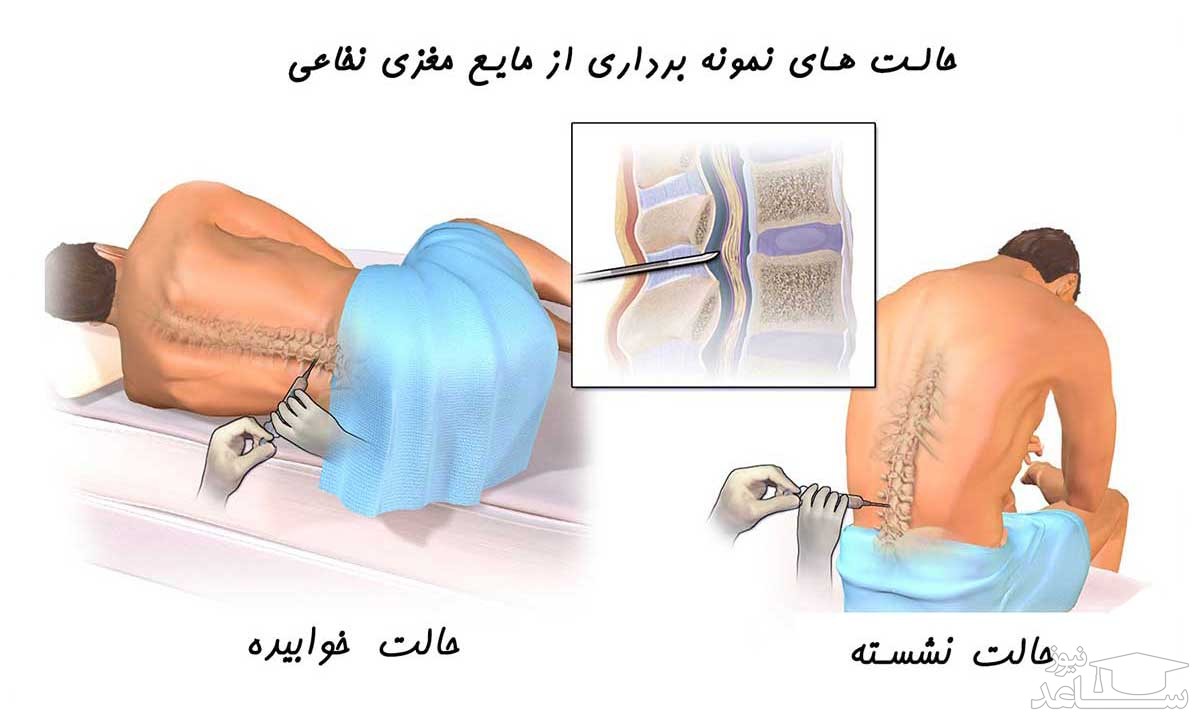 حالت های نمونه برداری از مایع مغزی نخاعی