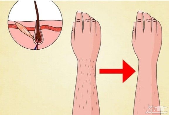 کاهش رشد موهای زائد بعد از چند جلسه لیزر