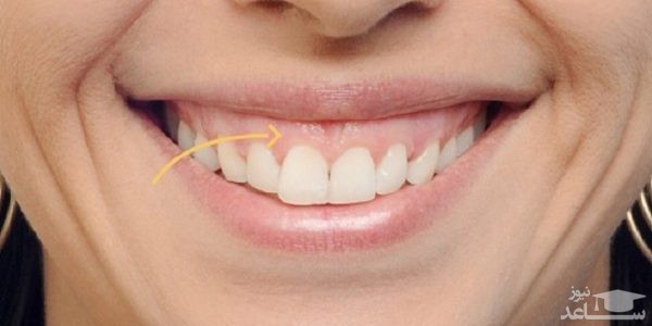 لبخند لثه ای