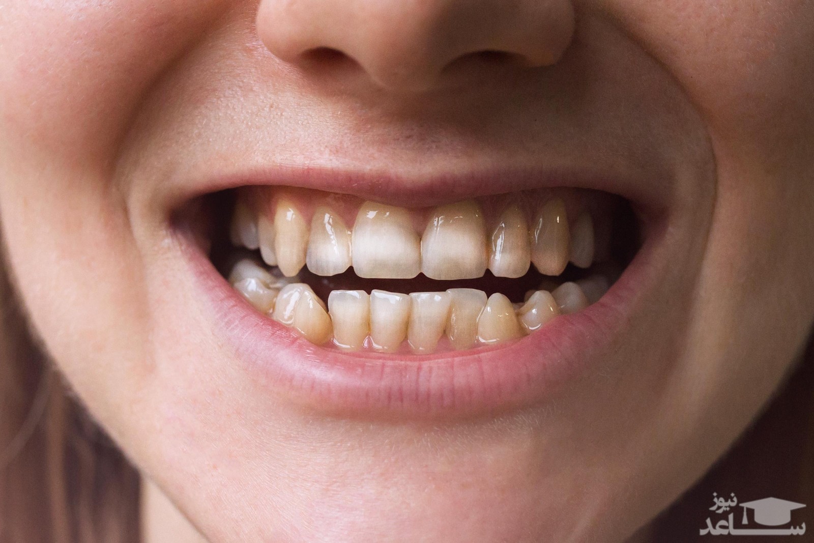 علل سیاه شدن لثه و راههای درمان آن