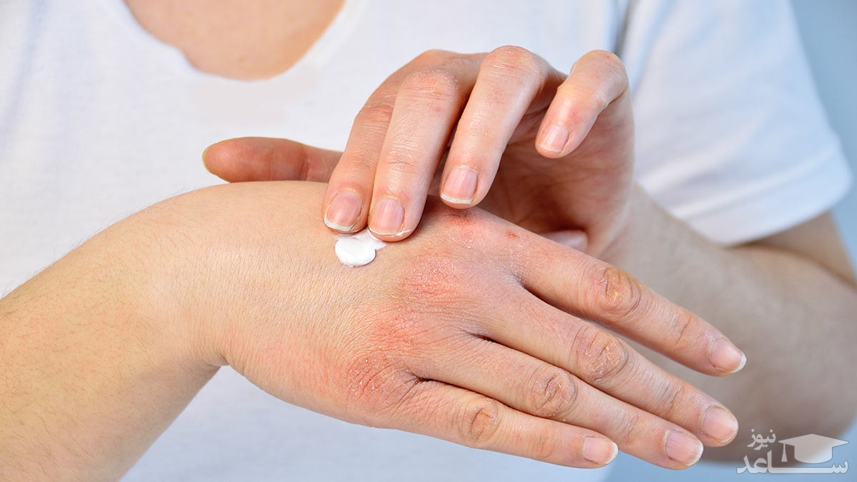 موارد منع مصرف و تداخل دارویی آسیترتین