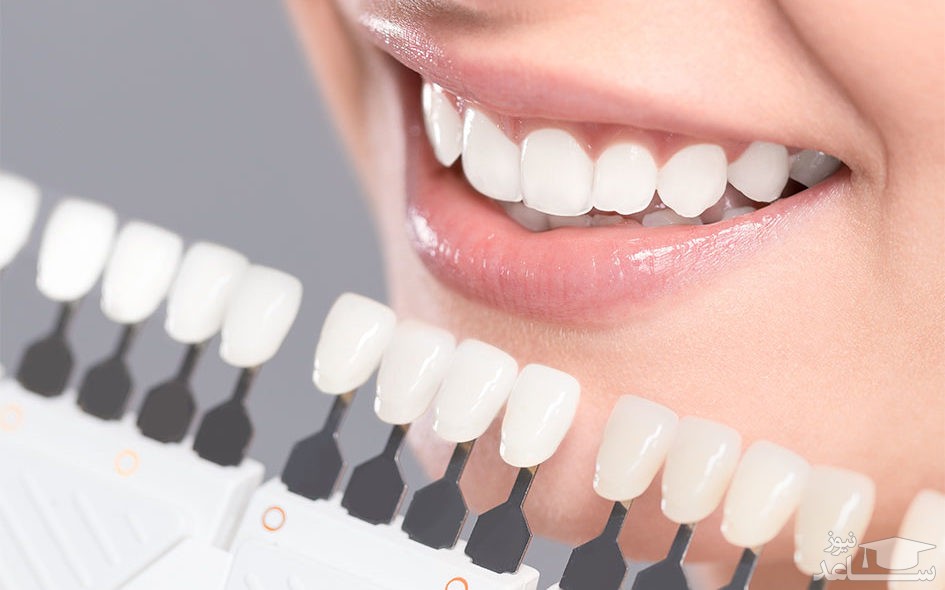 روکش های دندان و نحوه مراقبت از آن ها