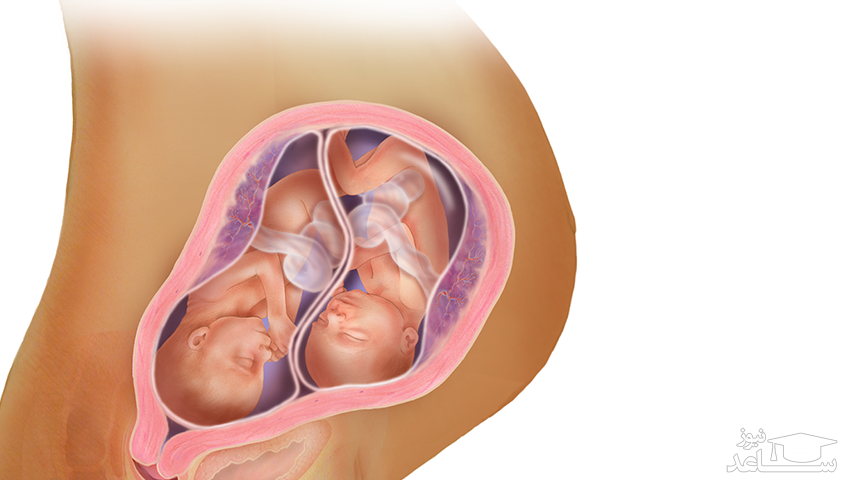 سندروم قل ناپدید شده چیست و چه علائمی دارد؟