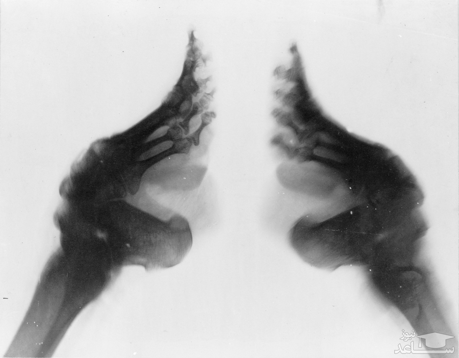 عکس رادیولوژی از پاهای بسته شده