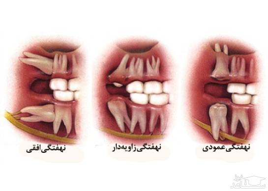 خطرات دندان نهفته