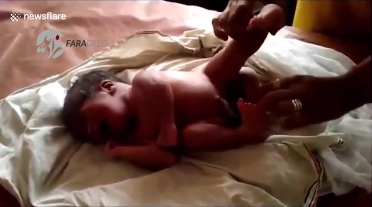 (فیلم) تولد نوزادی با 4 پا در هند