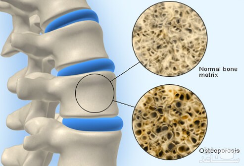 درمان پوکی استخوان با کمک نانوذرات