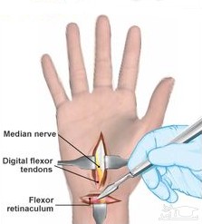  با تعویض عصب امکان درمان دست فلج میسر شد