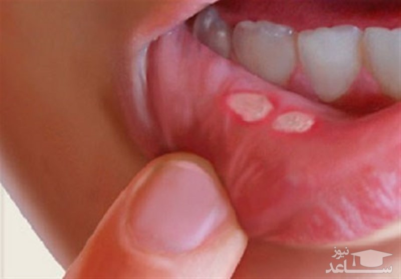 درمان سریع آفت دهان با روش های ساده خانگی