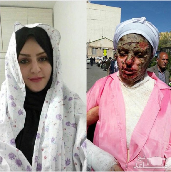 گفت‌وگو با «معصومه جلیل‌پور»، قربانی اسیدپاشی