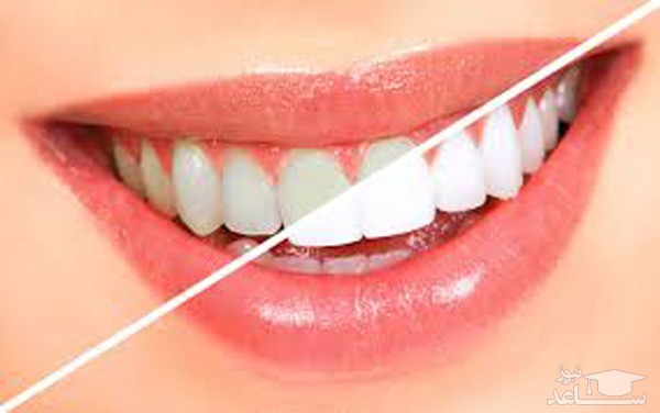 دندان های سفید از سلامت بالایی برخوردار نیستند !