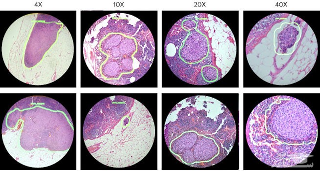 میکروسکوپ " واقعیت افزوده" برای تشخیص سرطان
