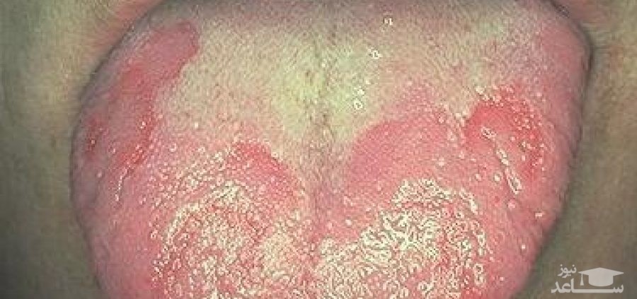 هشدار! لکه های سفید روی زبان را جدی بگیرید!