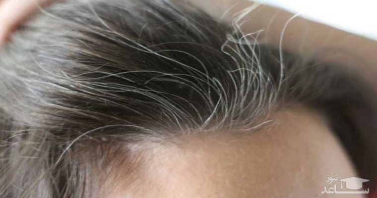 چرا موها در جوانی سفید میشوند؟