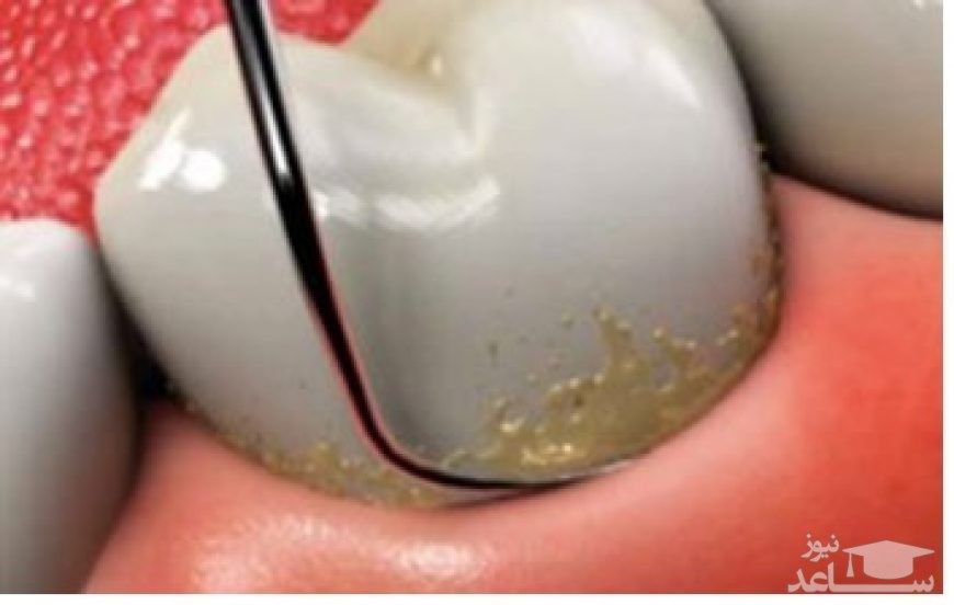آیا جرم گیری دندان مضر است؟
