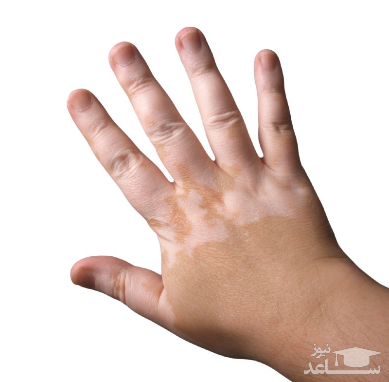 آشنایی با بیماری پوستی ویتیلیگو(Vitiligo ) و راه درمان آن