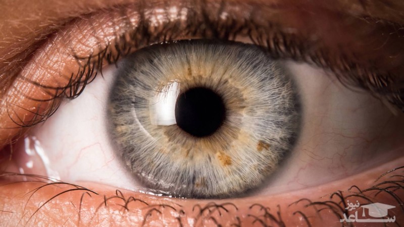 دلیل زردی چشم یا سندرم ژیلبرت چیست ؟