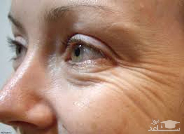 چروک های قسمت های مختلف صورت نشانه چیست؟