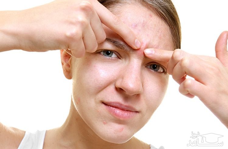 ترکاندن این جوش ها میتواند موجب مرگ شود!