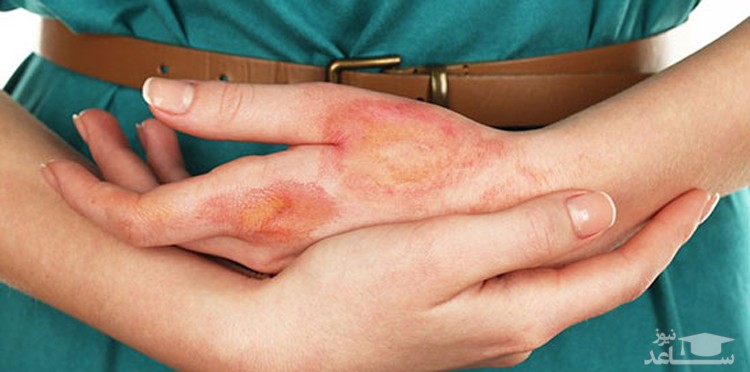 درمان سریع سوختگی در منزل