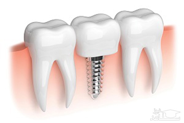 ایمپلنت دندانی برای چه کسانی مناسب نیست؟