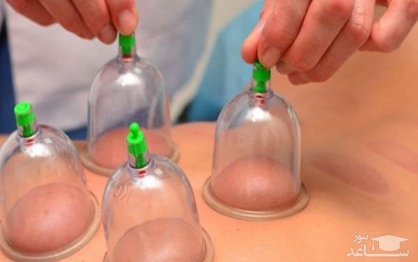 معایب و مضرات بادکش درمانی