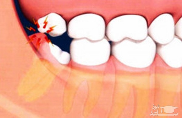 حتما باید دندان عقل کشیده شود؟