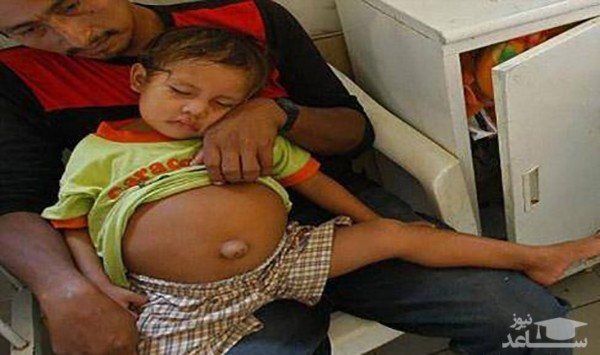حاملگی عجیب کودک 3 ساله در پرو !