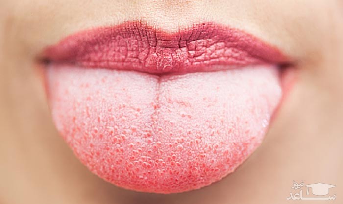 سفید شدن زبان نشان دهنده کدام بیماری هاست؟ درمان آن چیست؟