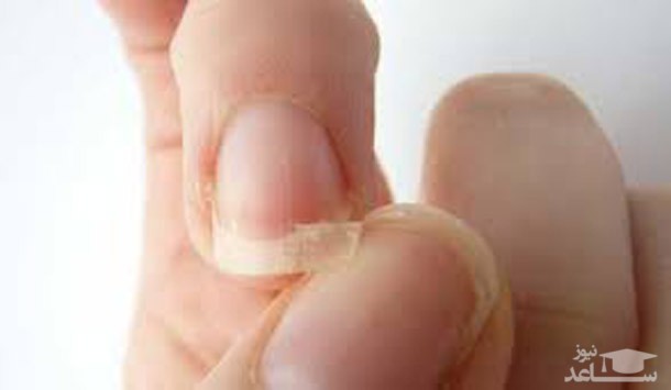 چرا ناخن ها پوسته پوسته شده و می شکنند؟