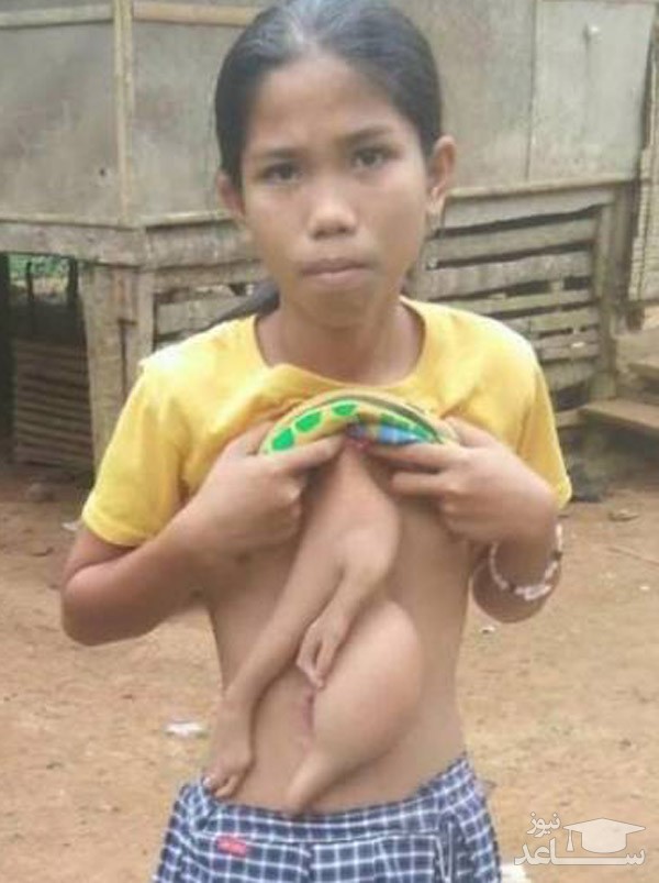 (عکس) دختر عجیب الخلقه فیلیپینی!