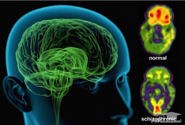 بیماری اسکیزوفرنی مرز بین نبوغ و جنون !