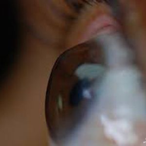 قوز قرنیه یا کراتوکونوس چه نوع بیماری چشمی است ؟