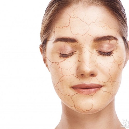 5 اشتباه که باید در درمان پوست خشک از آن‌ها خودداری کنید
