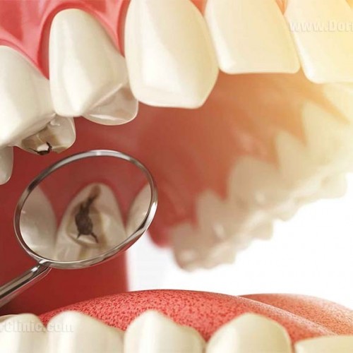 6 نوع از شکستگی دندان که باید فوری درمان شوند!