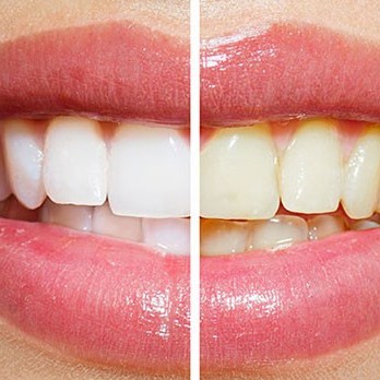 7 ماده ای که دندان هایتان را سفید می کنند!