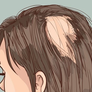 علایم و نشانه‌های ریزش موی سکه ای چیست؟
