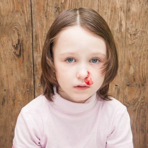 علائم و نشانه های شکستگی بینی کودک