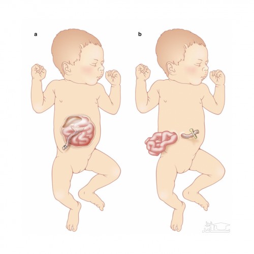 علل و عوامل امفالوسل جنین در بارداری