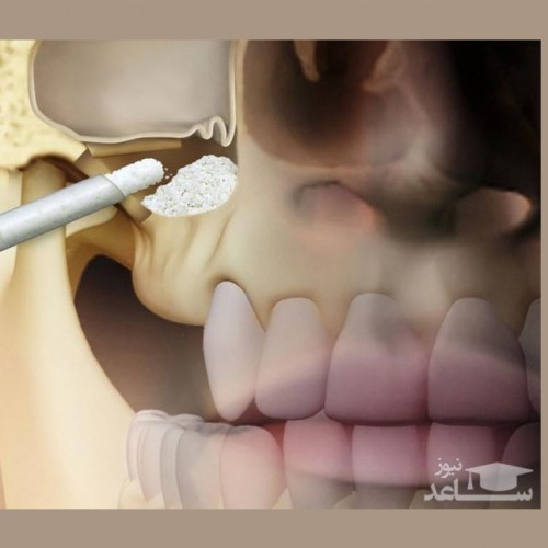 عمل سینوس لیفت دندان چیست؟