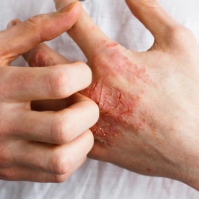 انواع سوختگی و درجات مختلف آن
