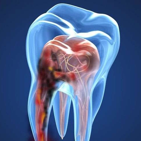 برای دندان درد شدید چه باید کرد؟