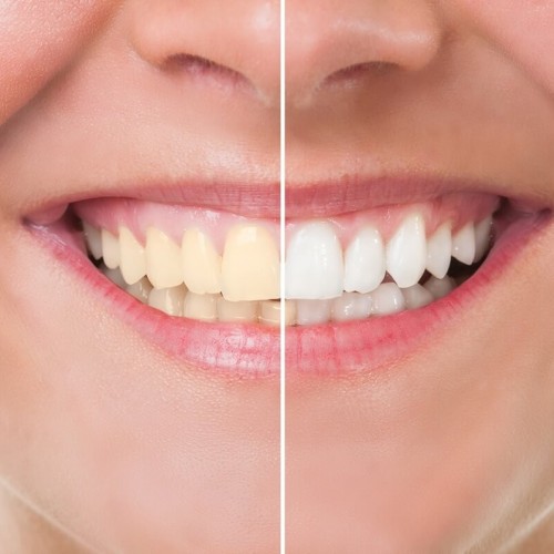 باندینگ دندان چیست و روش انجام آن