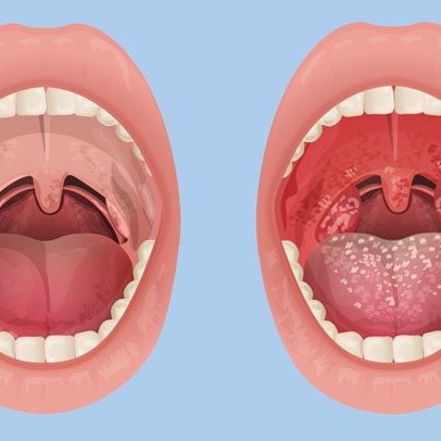 چرا التهاب زبان اتفاق می افتد؟