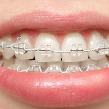 دلیل ایجاد لک روی دندان پس از ارتودنسی