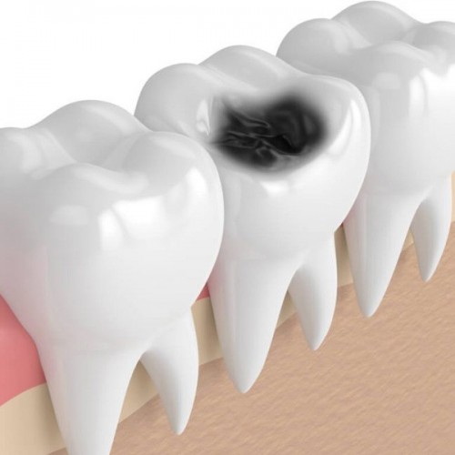 دندان پوسیده را چطور می‌توان تشخیص داد؟